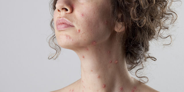 chickenpox varicella zoster virus