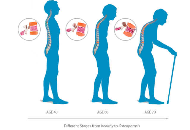 stages-of-osteoporosis5