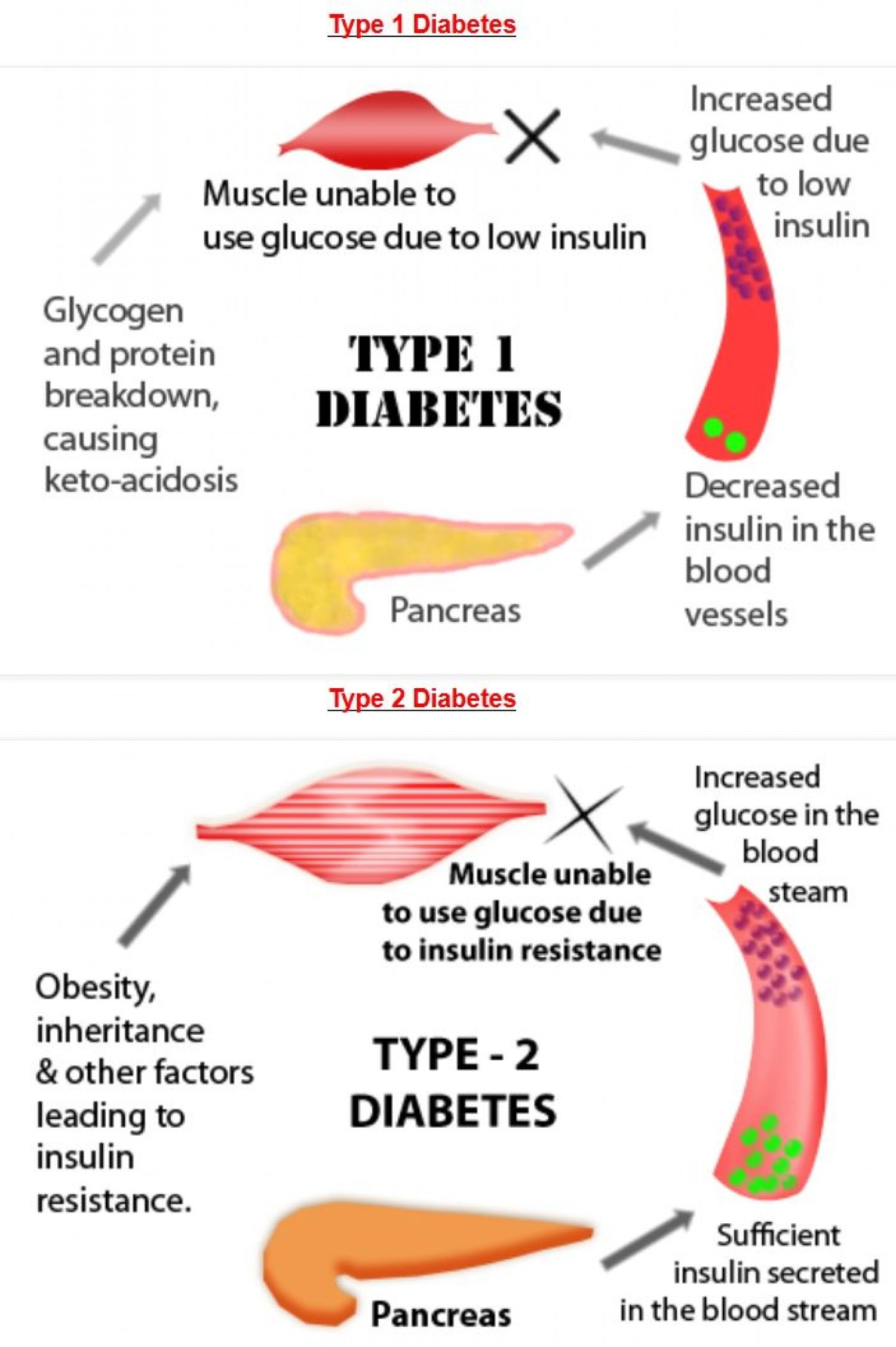 diabetes-type-1-diabetes-vs-type-2-diabetes_52fdbc414cd34_w1500