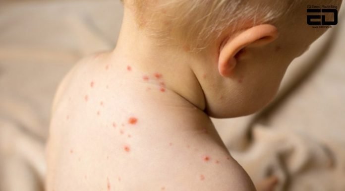 Watch: Why Is Measles Called “Mata” in India?