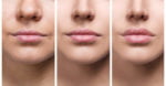Lips of young woman before and after augmentation