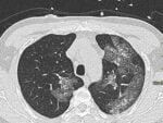 CT imaging of COVID