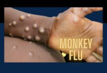 monkeypox