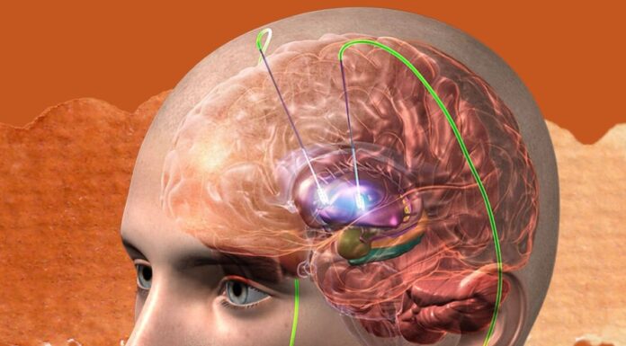 Australian Woman Gets Surgery For Depression In Mumbai: What Is That depression